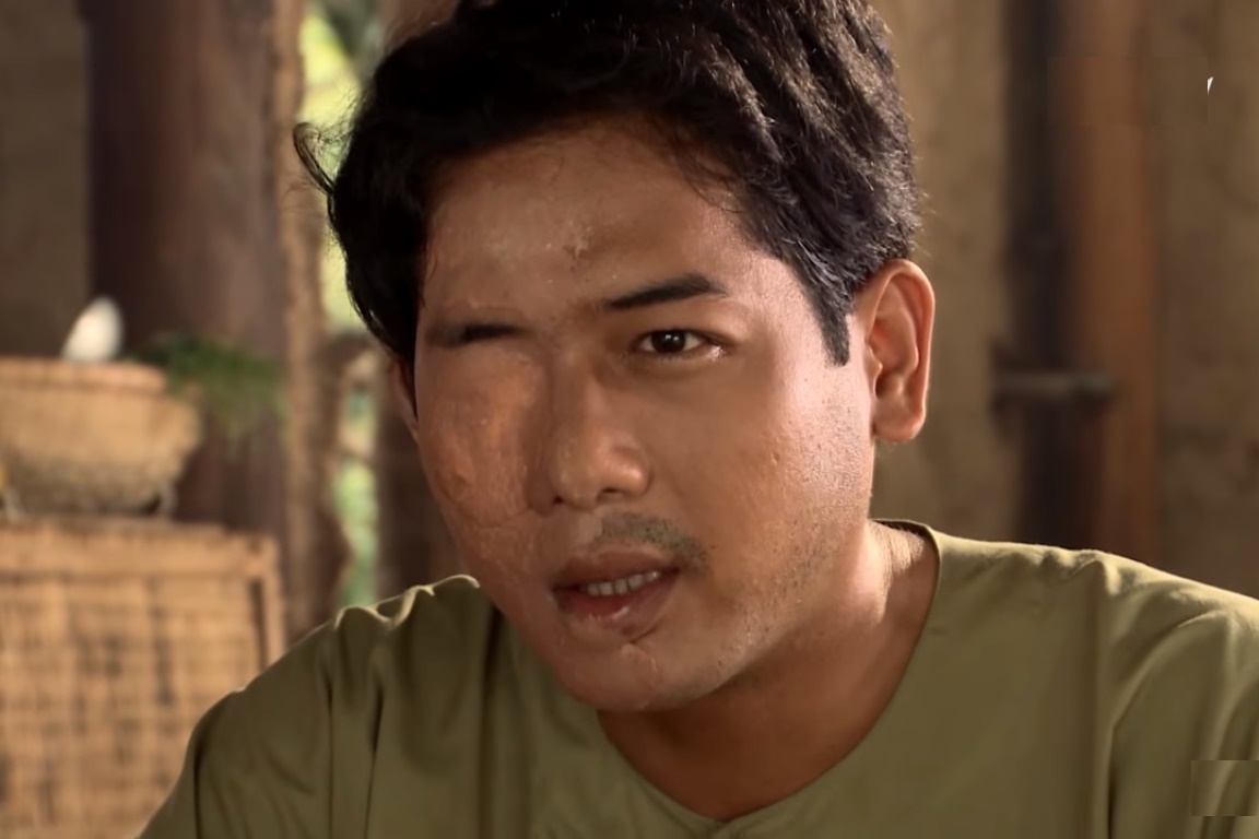 Khu&ocirc;n mặt sẹo của Đức Nh&atilde; tron